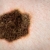 Una combinación de dos fármacos aumenta la eficacia del tratamiento del melanoma